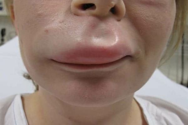 Angioedema